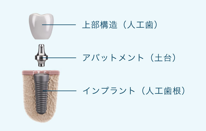 上部構造（人工歯）、アバットメント（土台）、インプラント（人工歯根）