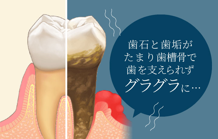 歯石と歯垢がたまり歯槽骨で歯を支えられずグラグラに