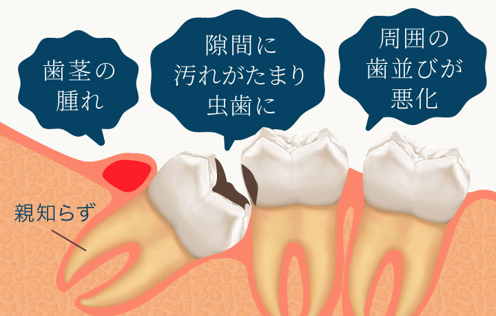 親知らず　歯茎の腫れ・隙間に汚れがたまり虫歯に・周囲の歯並びが悪化